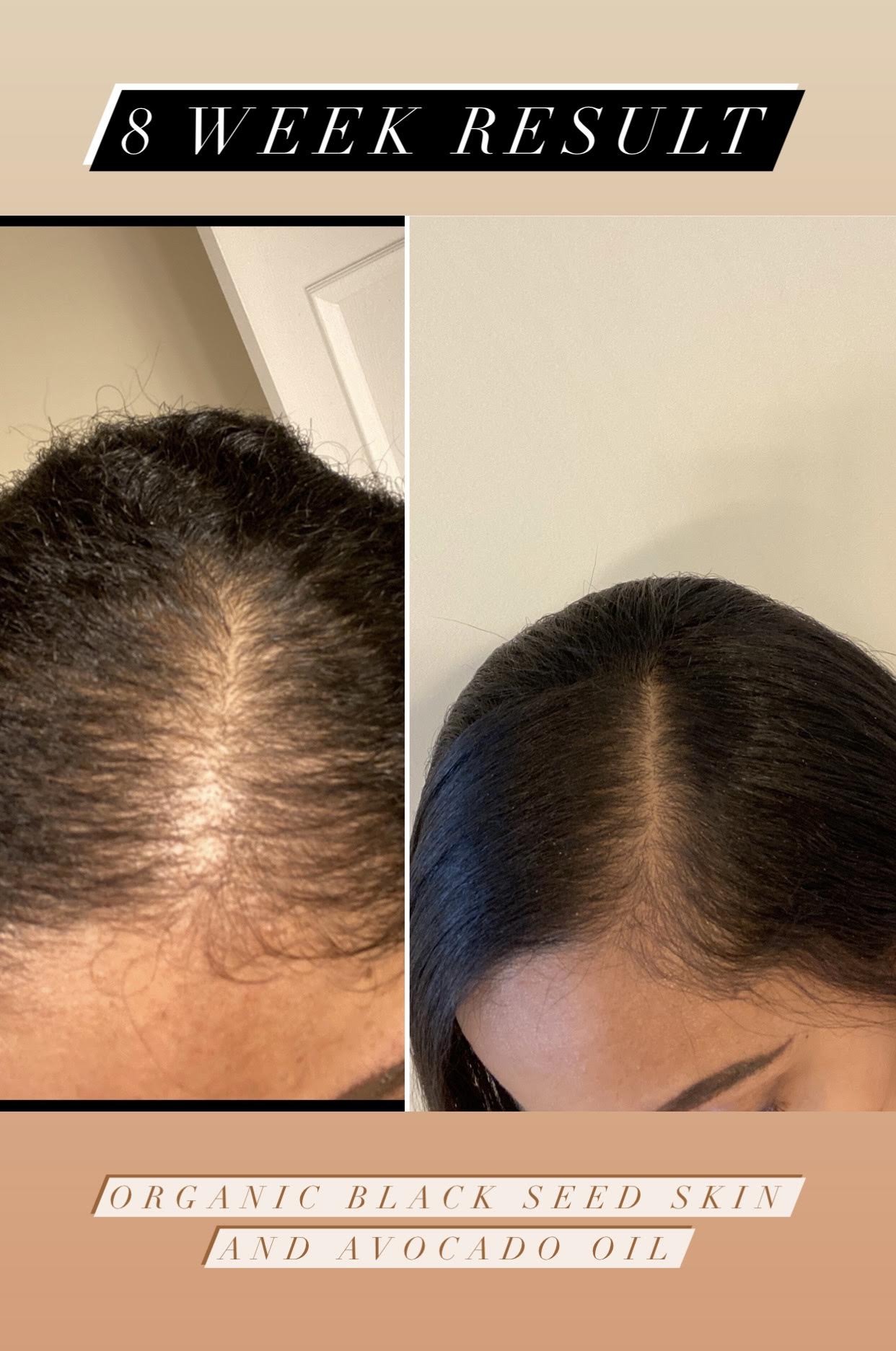 Black seed oil hair growth best sale before and after